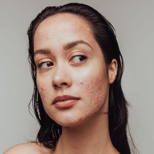 a profile photo of a woman with acne