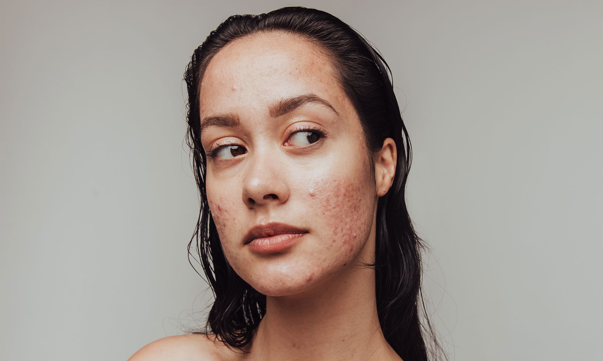 a profile photo of a woman with acne