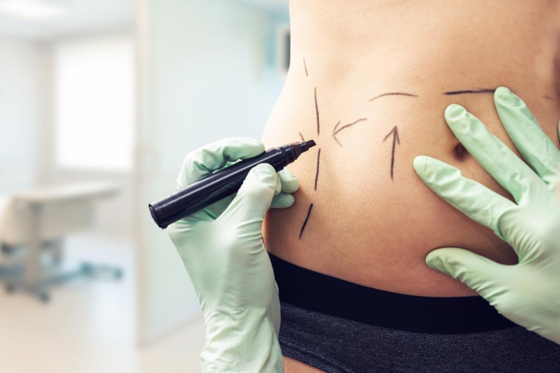 a woman having lines drawn on her torso for cosmetic surgery