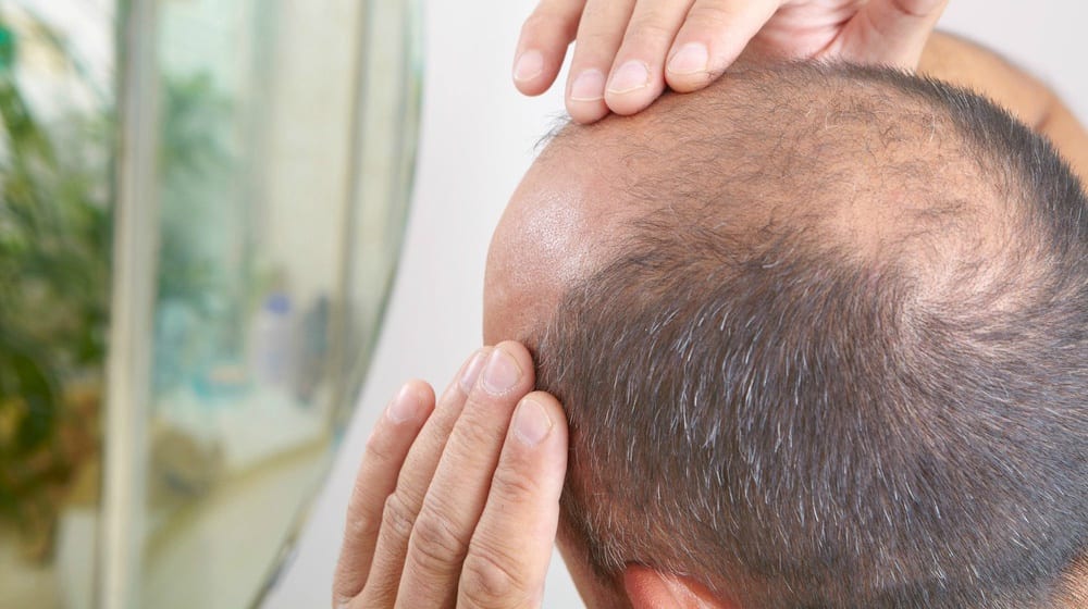 6 Proven Ways to Regrow Hair in Bald Spots - YEG Fitness