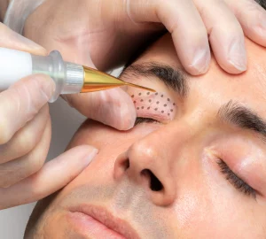 a man receiving a plasma pen treatment on his eyes